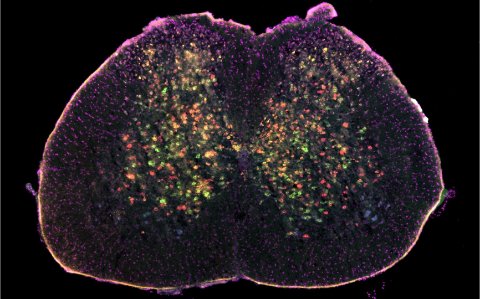 Researchers use AI to uncover the progression of ALS
